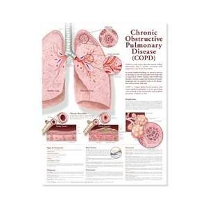 Chronic Obstructive Pulmonary Disease (COPD) Anatomical Chart, 2nd 
