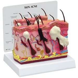Normal/Acne Skin Dermatology Anatomy Model #3751  